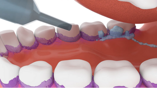 Ventilator Associated Pneumonia: Development and prevention